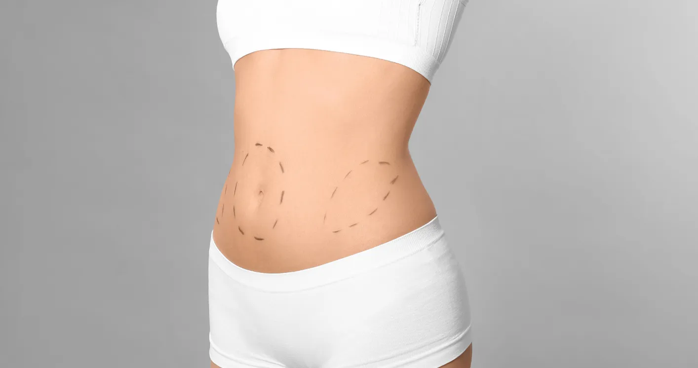 Abdominoplasty (Tummy Tuck)