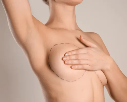 Breast Surgery (Mammoplasty)